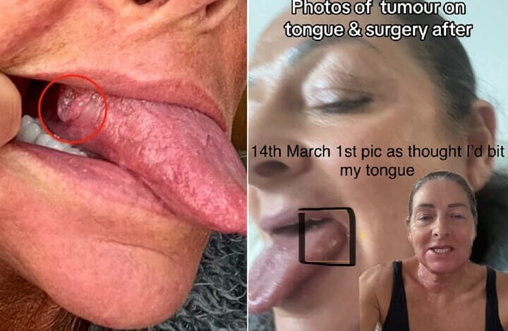 【画像】 舌がこうなっていたら・・医師がひと目で「癌」と診断した「口の中」