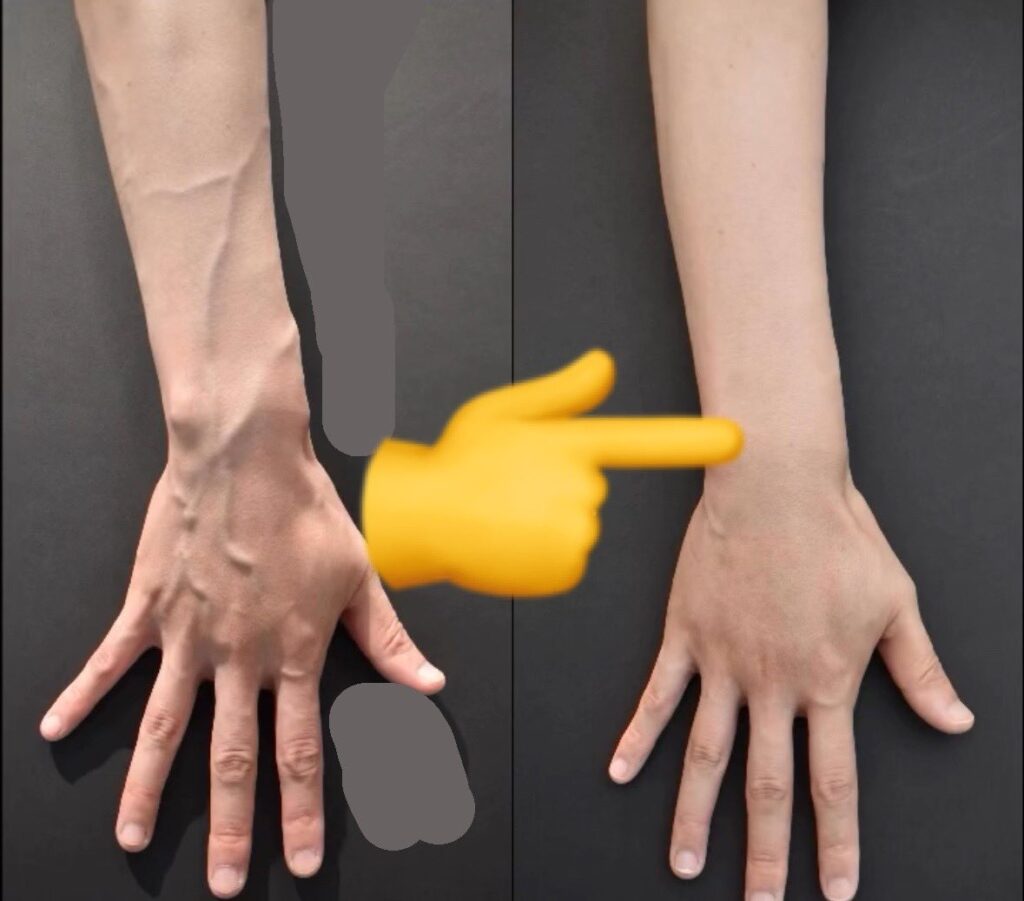 浮き出た腕の血管を潰して美しくする「ハンドベイン」手術が流行る