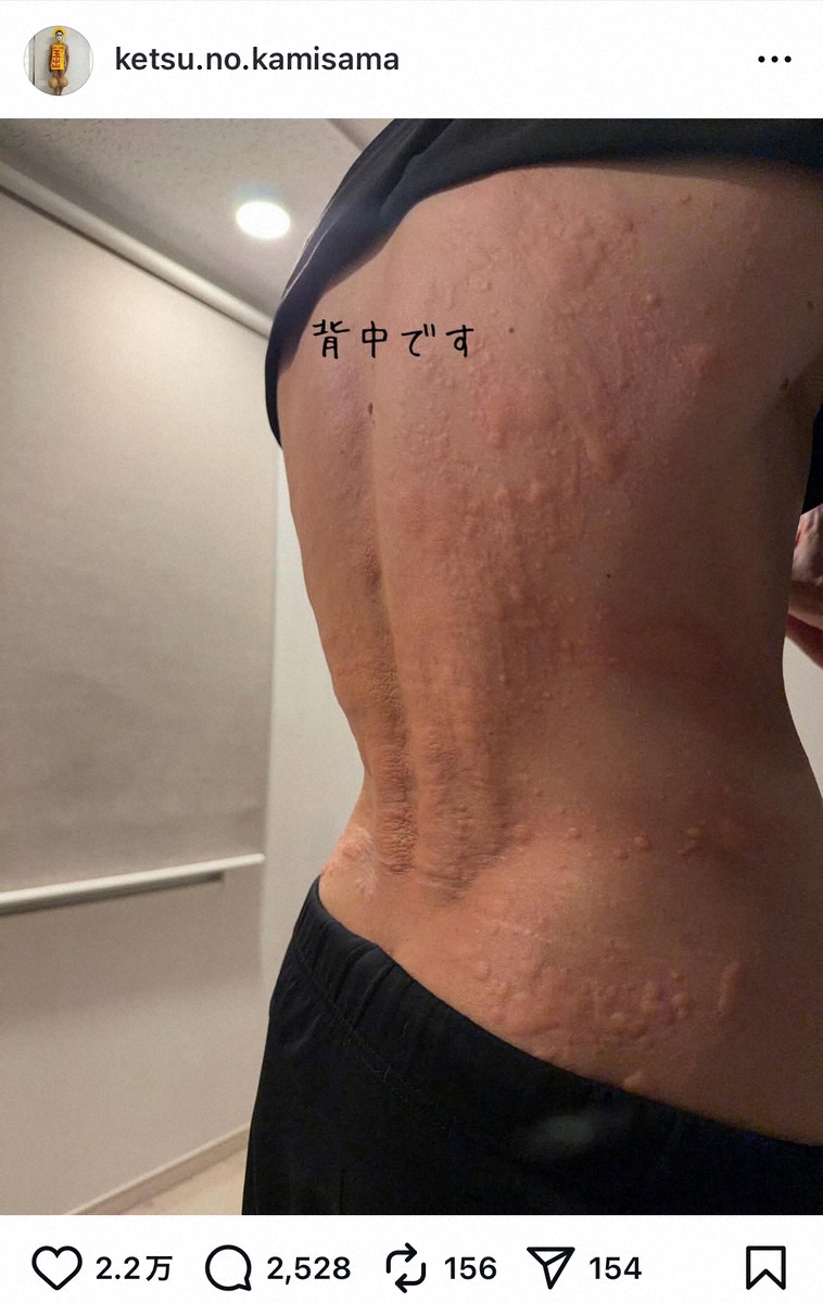 金爆・樽美酒研二45歳　原因不明の病告白　「これ酷い時」背中一面に蕁麻疹…心配の声殺到