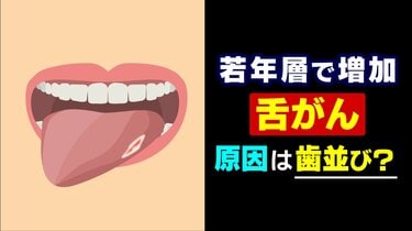 【健康】20年で倍増…増える若年層の「舌がん」 現代人特有の “狭い歯並び” が引き金に? 口内炎との決定的な違いとは
